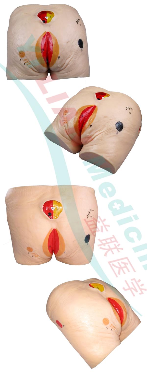 高級老年人褥瘡(壓瘡)護(hù)理模型